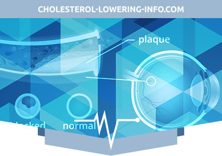 High Cholesterol - Eye sight